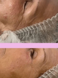 Résultat après une séance de microneedling
