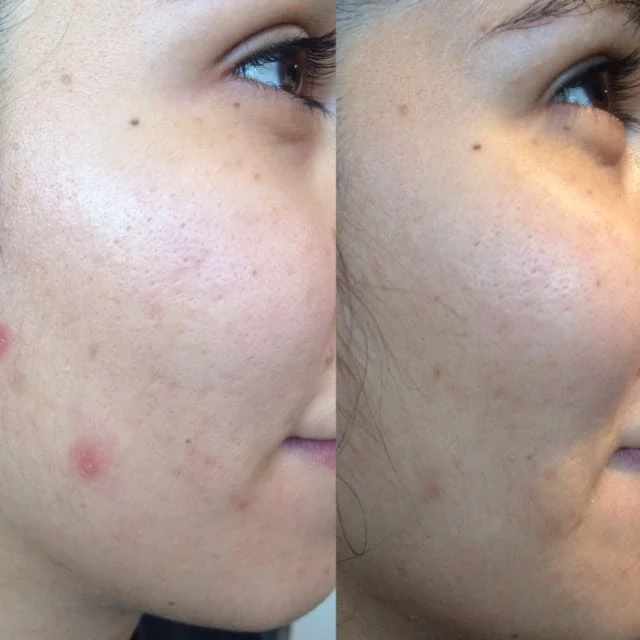 peeling solution for acne