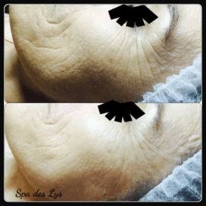peeling solution for wrinkles