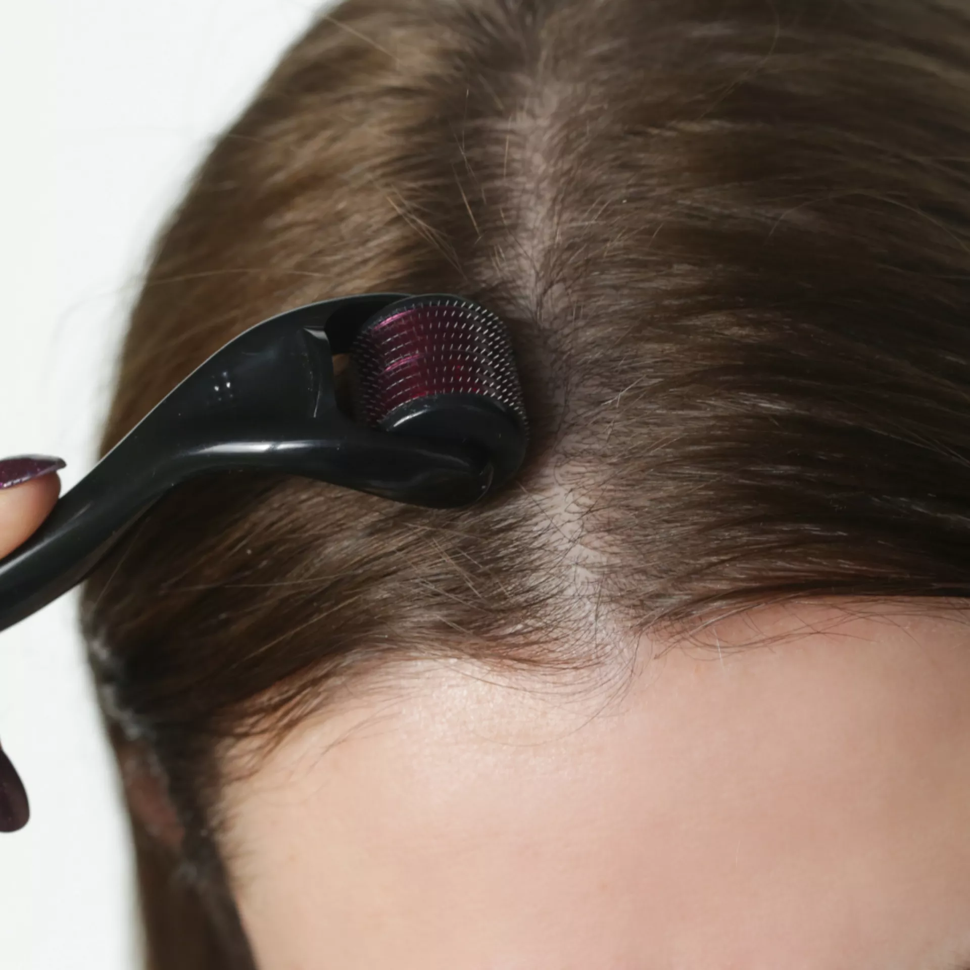 De voordelen van microneedling voor gezond haar: de centrale behandeling van de Total Hair Solution
