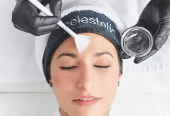 peeling-chimique-professionnel