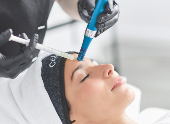 Le Microneedling 