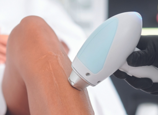 Laserontharing vóór de zomer: de juiste timing voor veilige en doeltreffende resultaten