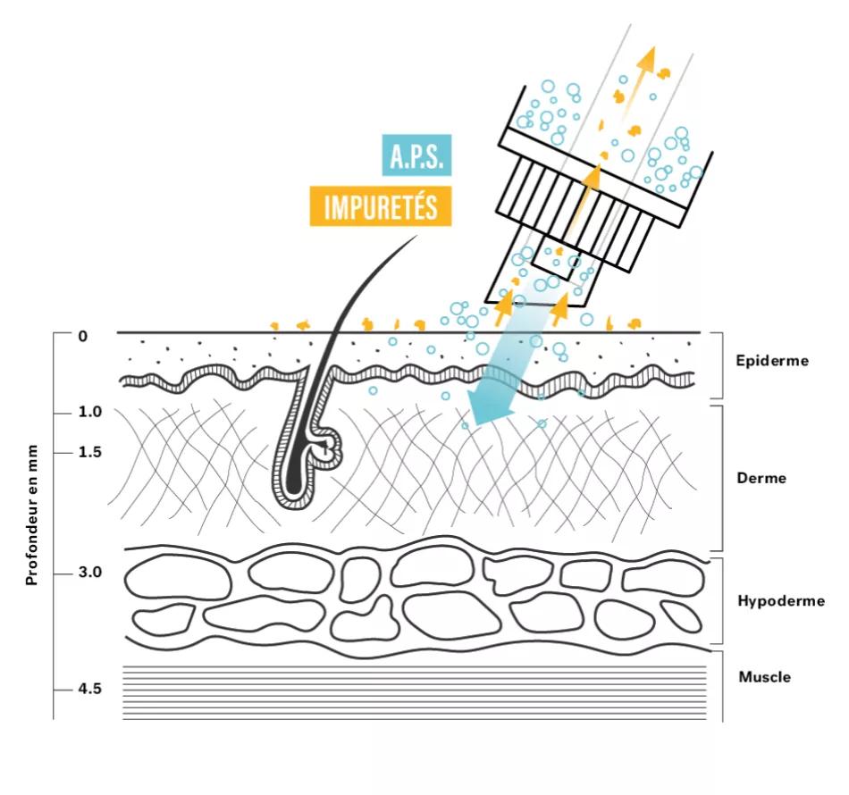 Hydromicrodermabrasion, the trendy treatment for gentle cleansing