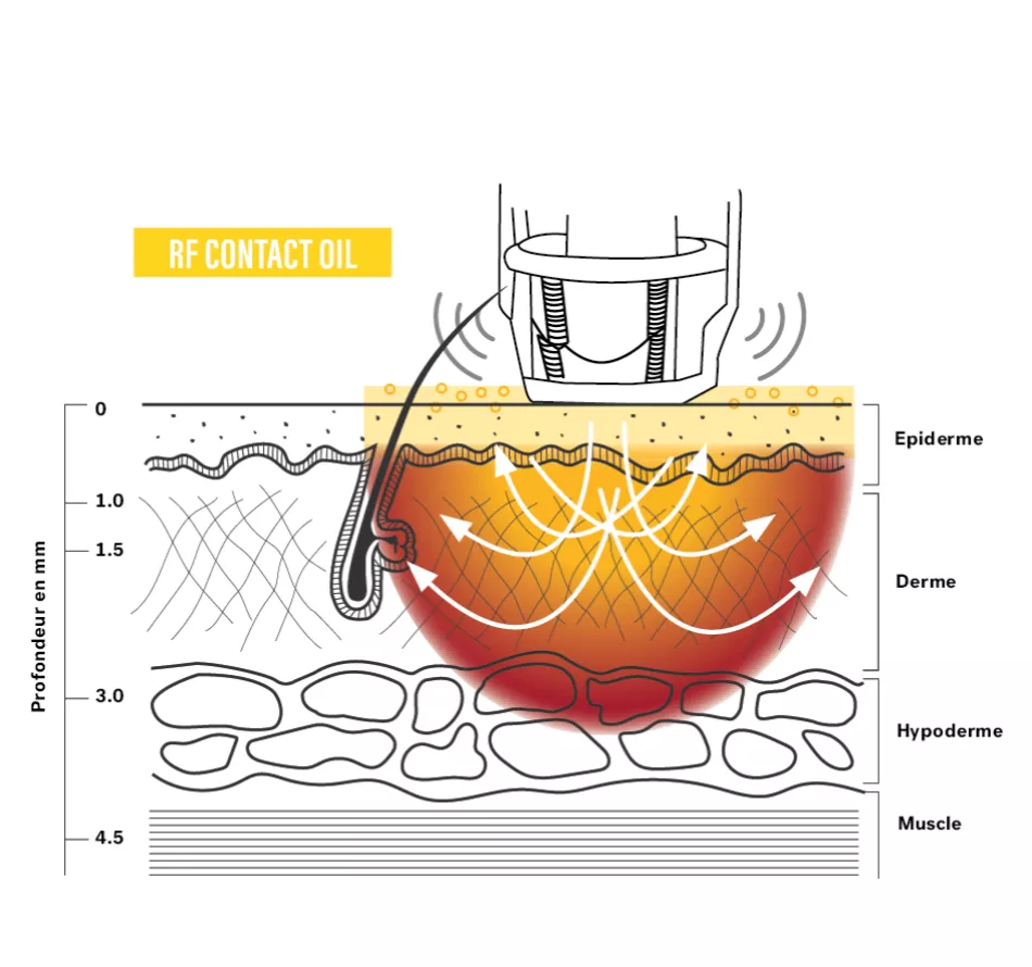 Thermal energy for beauty