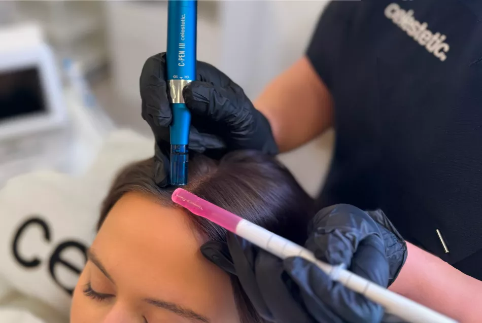Step 2: Microneedling and Hair Growth