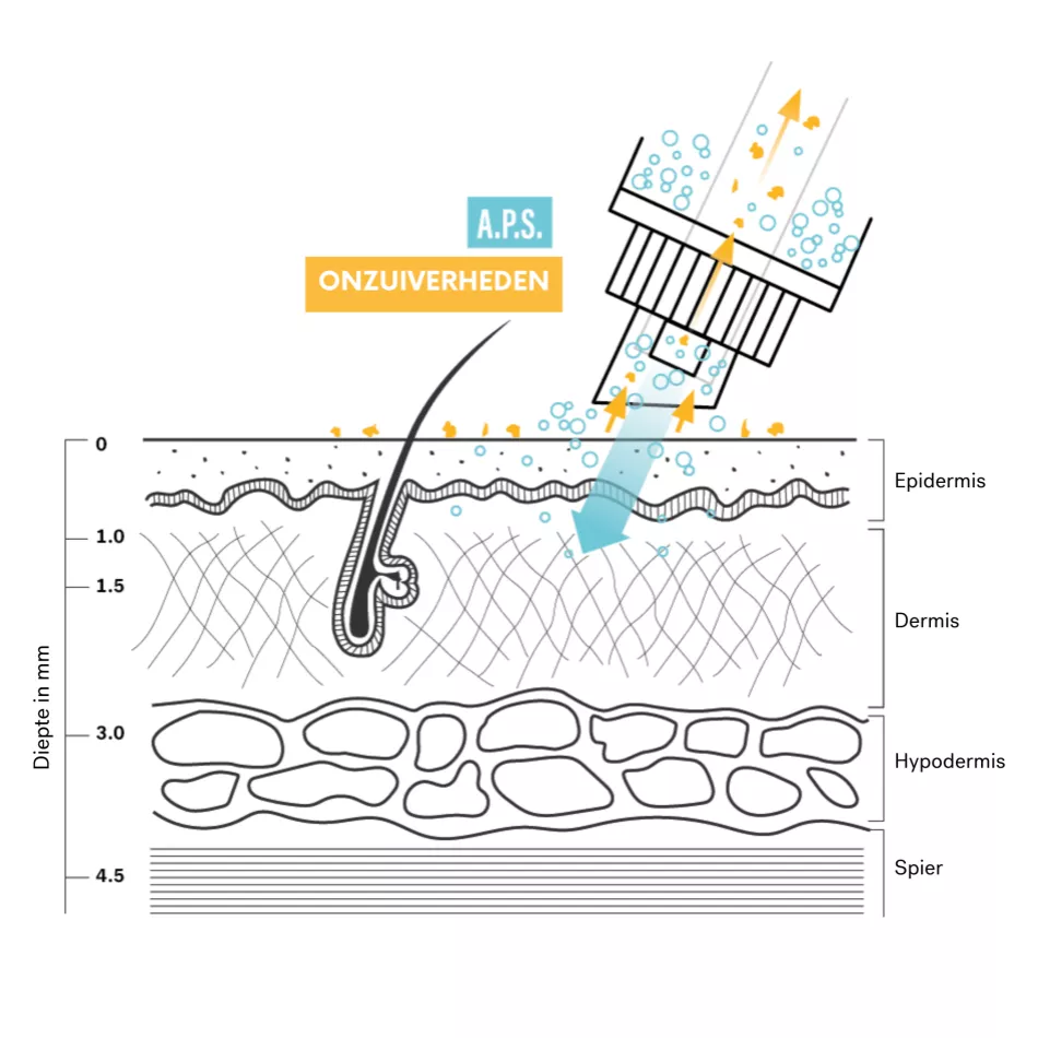 Hydromicrodermabrasie, de trendy behandeling voor een zachte reiniging