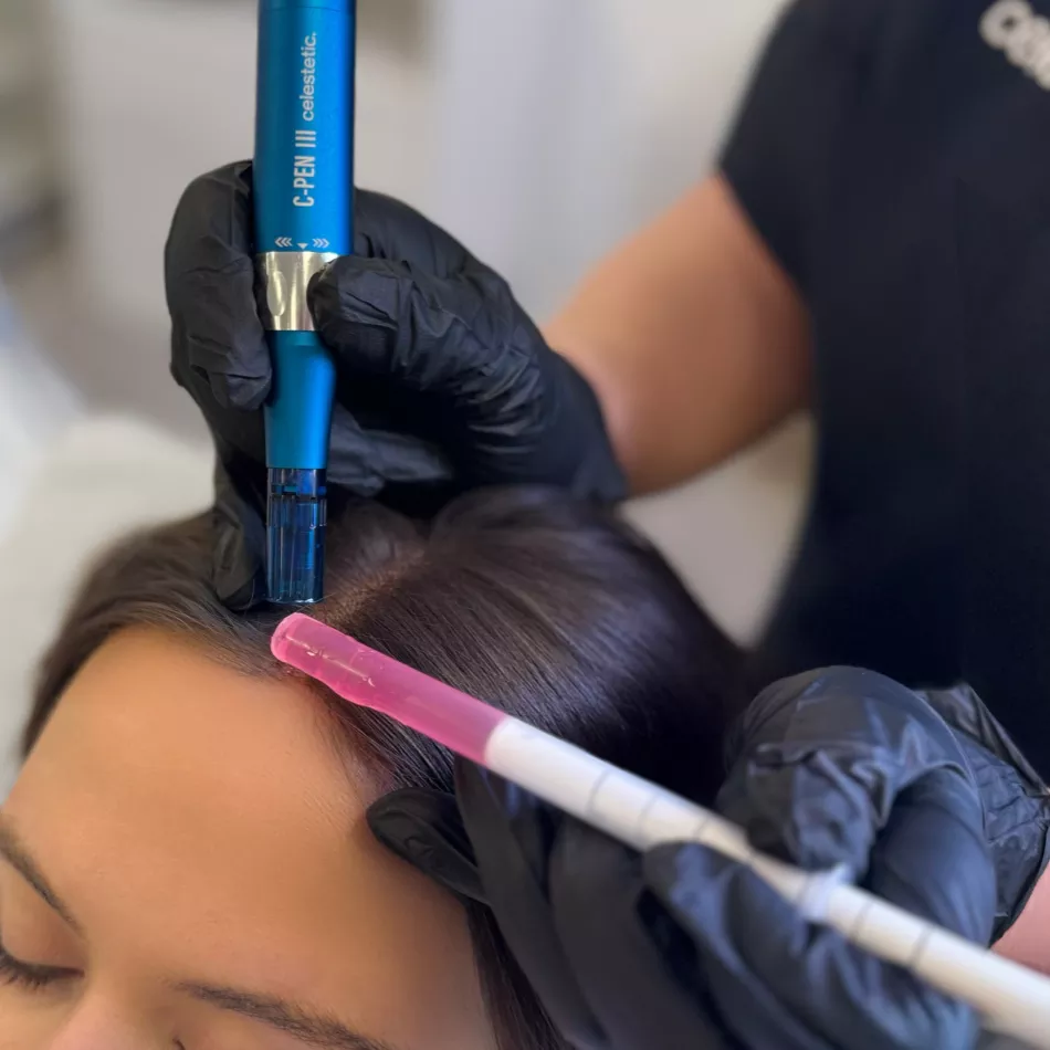 Step 2 | Microneedling & Hair Growth